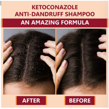 New Ketokem - Bottle of 110ml Anti-Dandruff Shampoo Pack of - 1